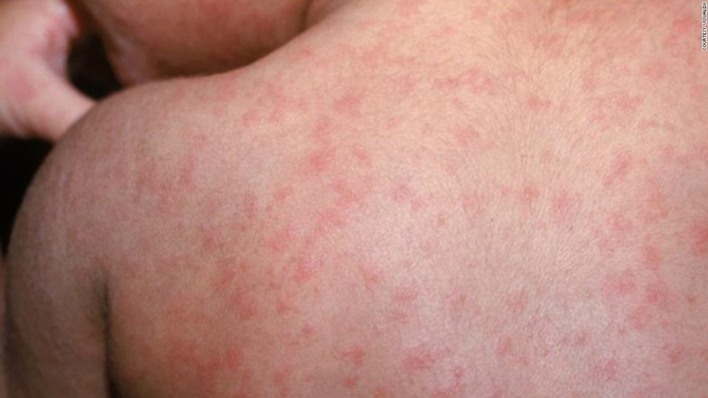 Belize monitors over 20 contacts after confirming five new measles cases