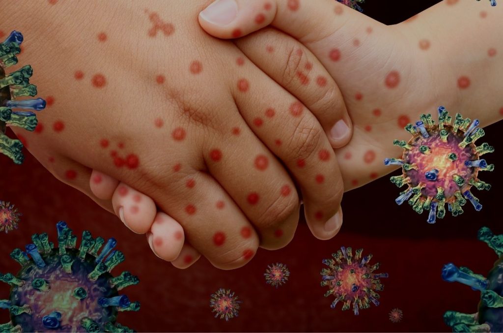 Belize confirms 22 measles cases as Ministry urges public to vaccinate