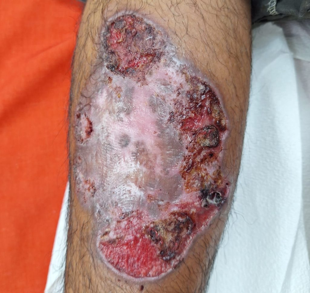 Health officials confirm second human screwworm case in Cayo District