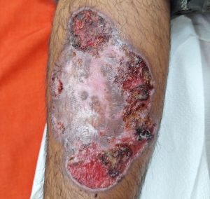 Health officials confirm second human screwworm case in Cayo District